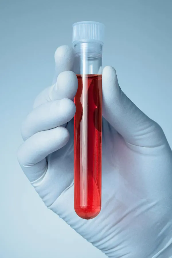 Autoimmune-Treatment A close-up of a doctor's gloved hand holding a vial a plasma, signifying autoimmune disease treatment from Discovery Health Healing Center in Green Bay.