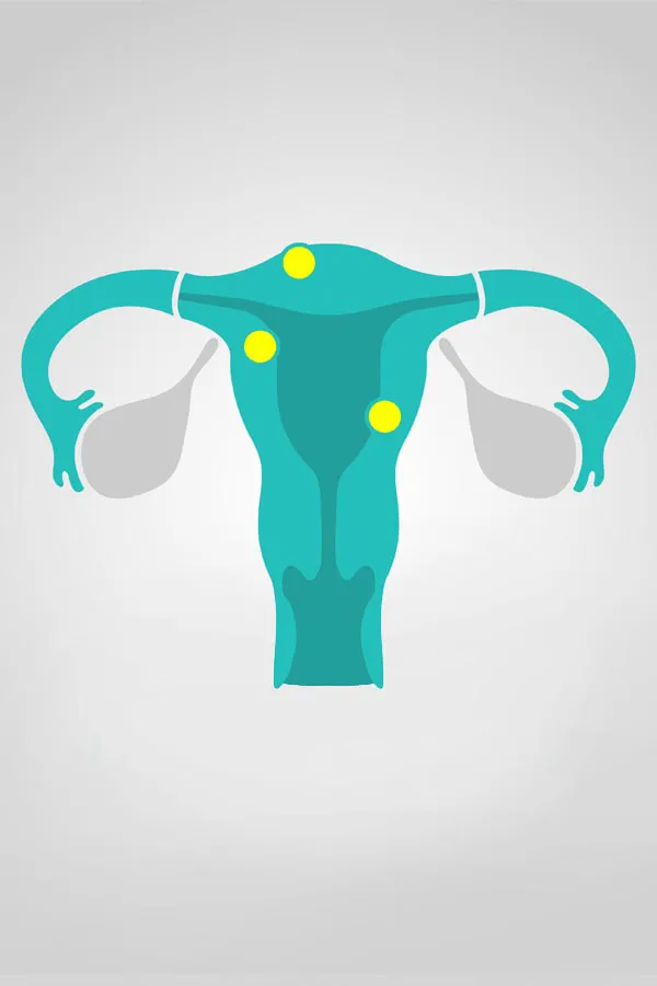 Fibroids-Treatment Illustration of a uterus with yellow dots indicating fibroids. Get treatment for fibroids from Discovery Health Healing Center in Green Bay.