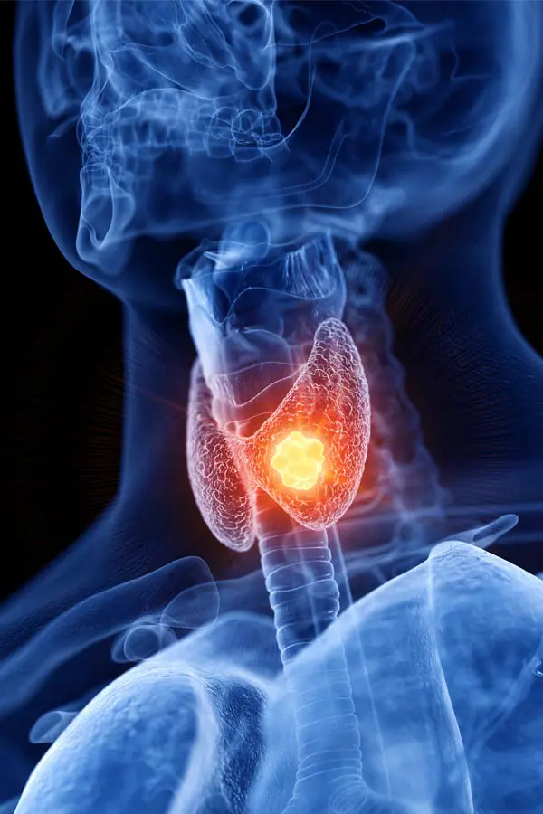 Thyroid-Imbalance-Treatment A 3D illustration of an x-ray of a human neck, highlighting the thyroid. Get help with thyroid imbalance from Discovery Health Healing Center in Green Bay.