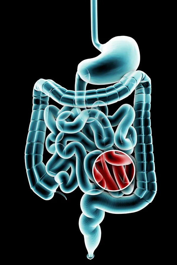 Ulcerative-Colitis-Treatment 3D illustration of the digestive system in blue tones, with an area of discomfort in red tones. Get treatment for Ulcerative Colitis from Discovery Health Healing Center in Green Bay.